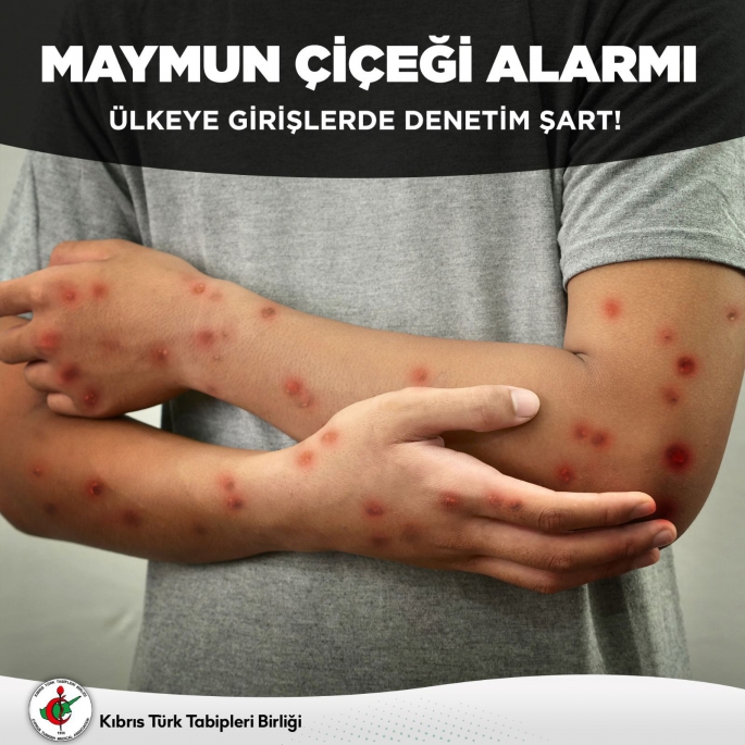 Tabipler, maymun çiçeği konusunda uyardı: Ülkeye girişlerde denetim
